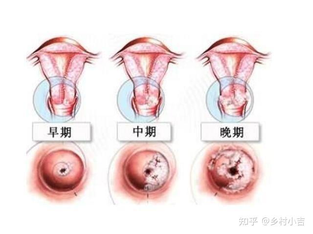 关于一名十二岁女孩感染HPV，应对与防治策略的探讨_反馈意见和建议