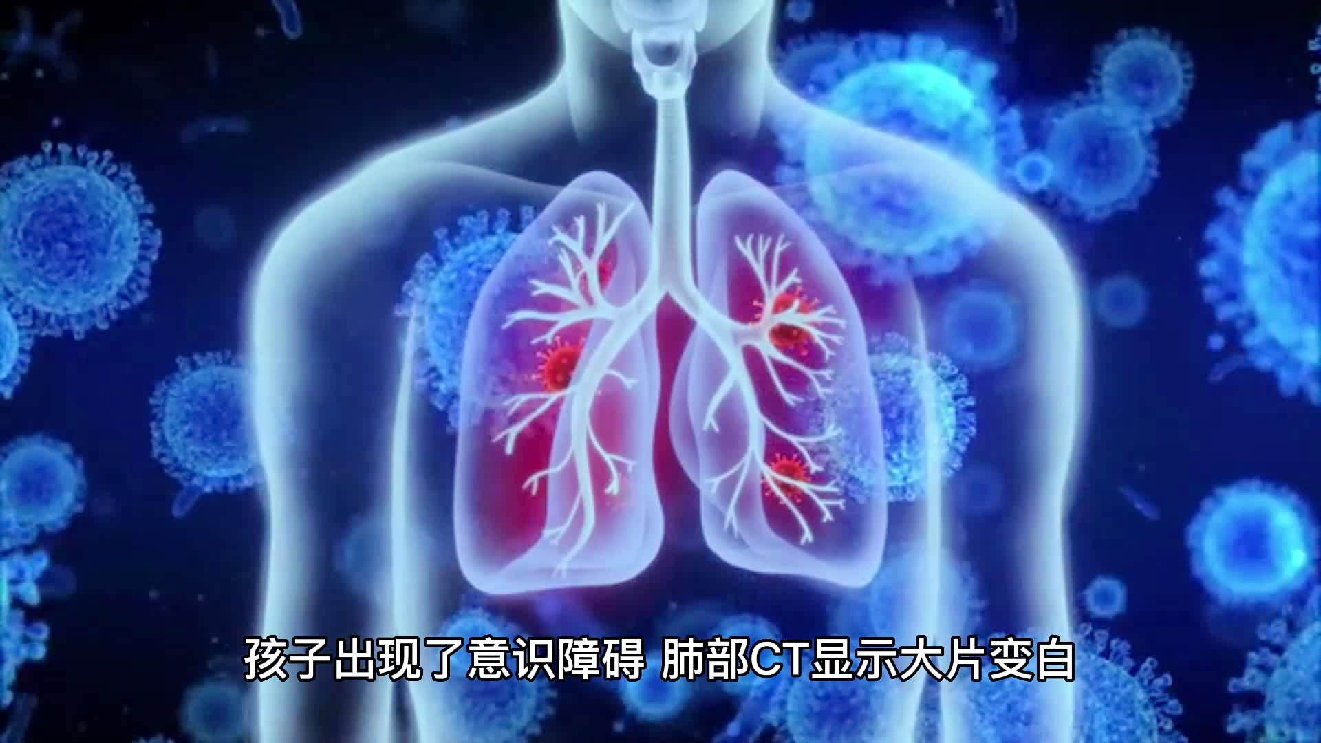 男子甲流后发烧一查竟成病毒性肺炎——警惕流感并发症的重要性