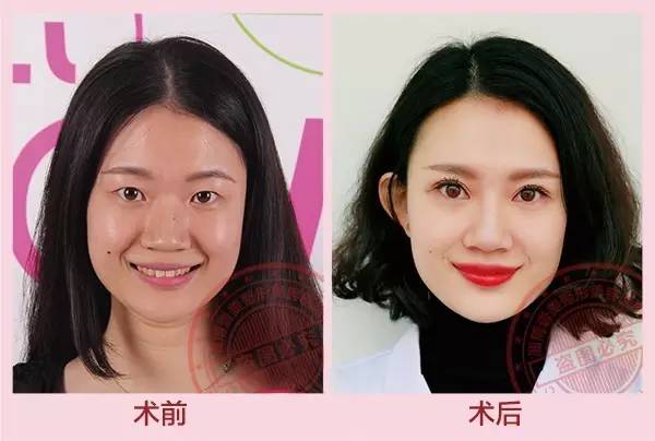 为什么人老了鼻子会变大