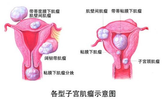 39岁长36枚子宫肌瘤